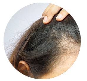 Beispiel für dünner werdendes Haar