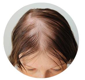 Beispiel für Frau mit Haarausfall