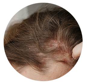 Beispiel für empfindliche Kopfhaut mit Ausschlag und Juckreiz