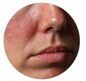 Beispiel für gereizte Haut