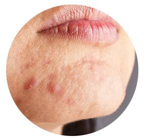 Beispiel für Hautprobleme am Kinn