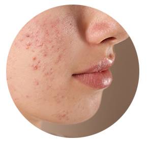 Beispiel für entzündete Gesichtshaut