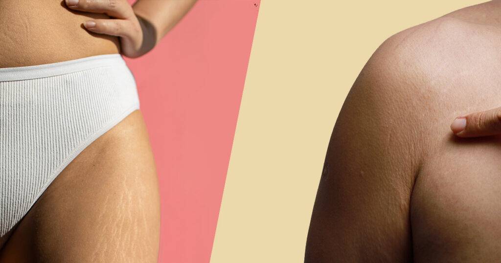 Bindegewebsschwäche: Frauen & Männer gleichermaßen betroffen